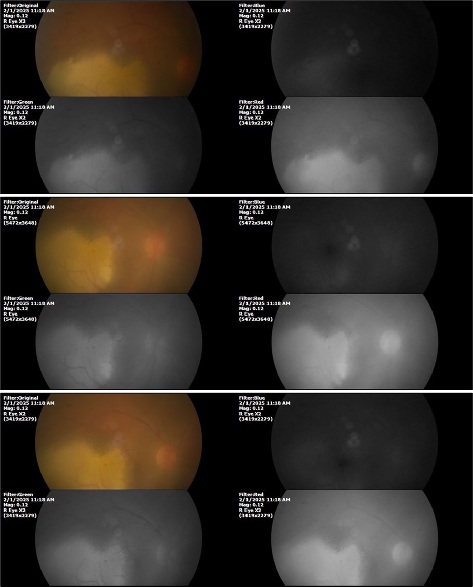 The photographs show a whitish mass in the place occupied by the blood, which is compatible with the term "ghost cells" used to refer to the accumulations of cell membranes of empty erythrocytes. Bleeding has not increased anymore.