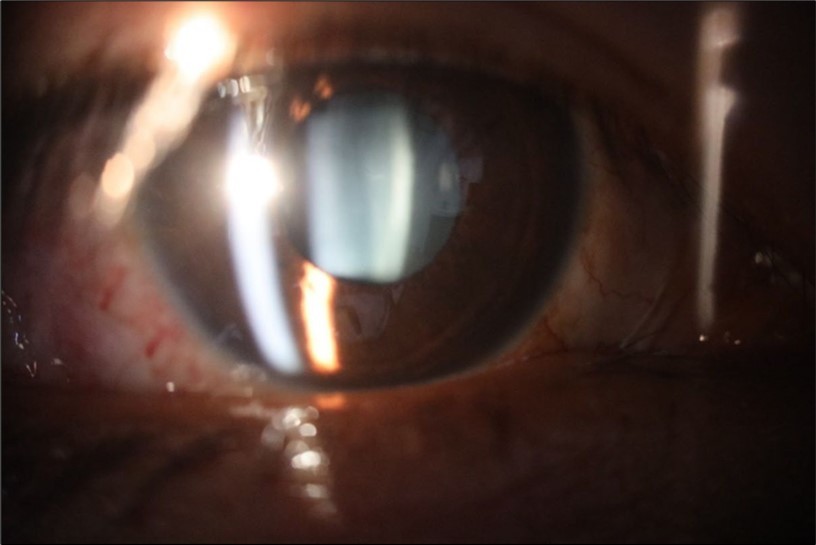 The slit-lamp photograph shows the anterior segment, relatively unscathed, in terms of transparent media (Cornea, crystalline and vitreous).