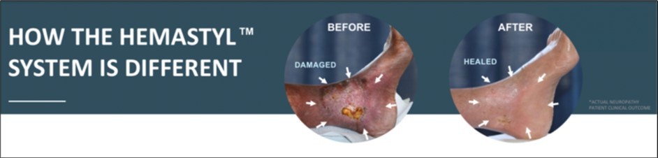 The above patient was diagnosed for an amputation but did not schedule his amputation and enrolled in our feasibility study instead. His previous treatment consisted of the current standard of care which was ineffective in healing his leg and wound. Hemastyl™ is a dual action product, healing neuropathy while eliminating harmful microbes.